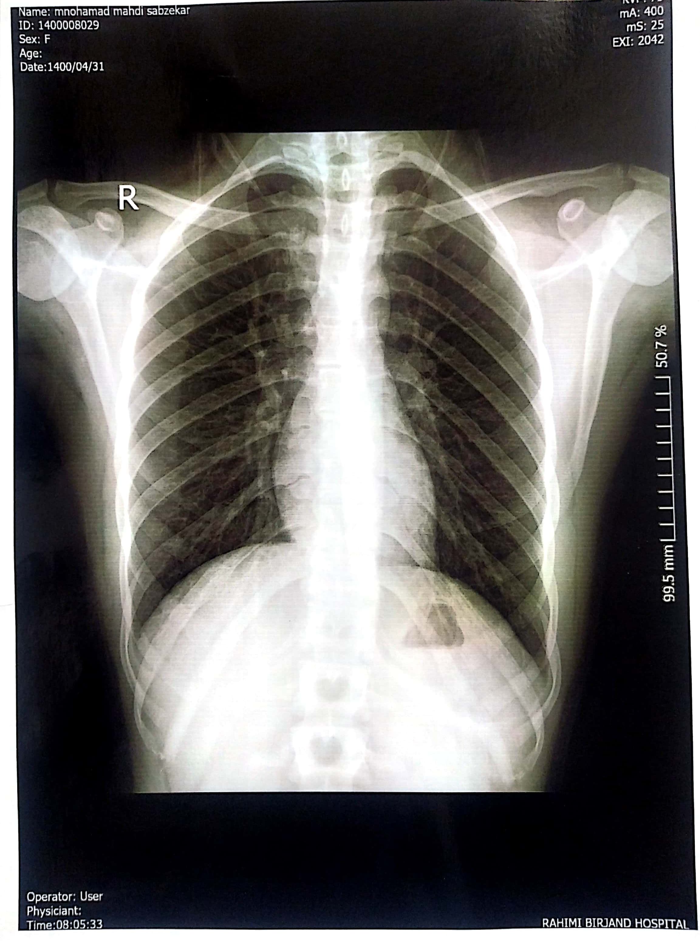 Chest X-ray