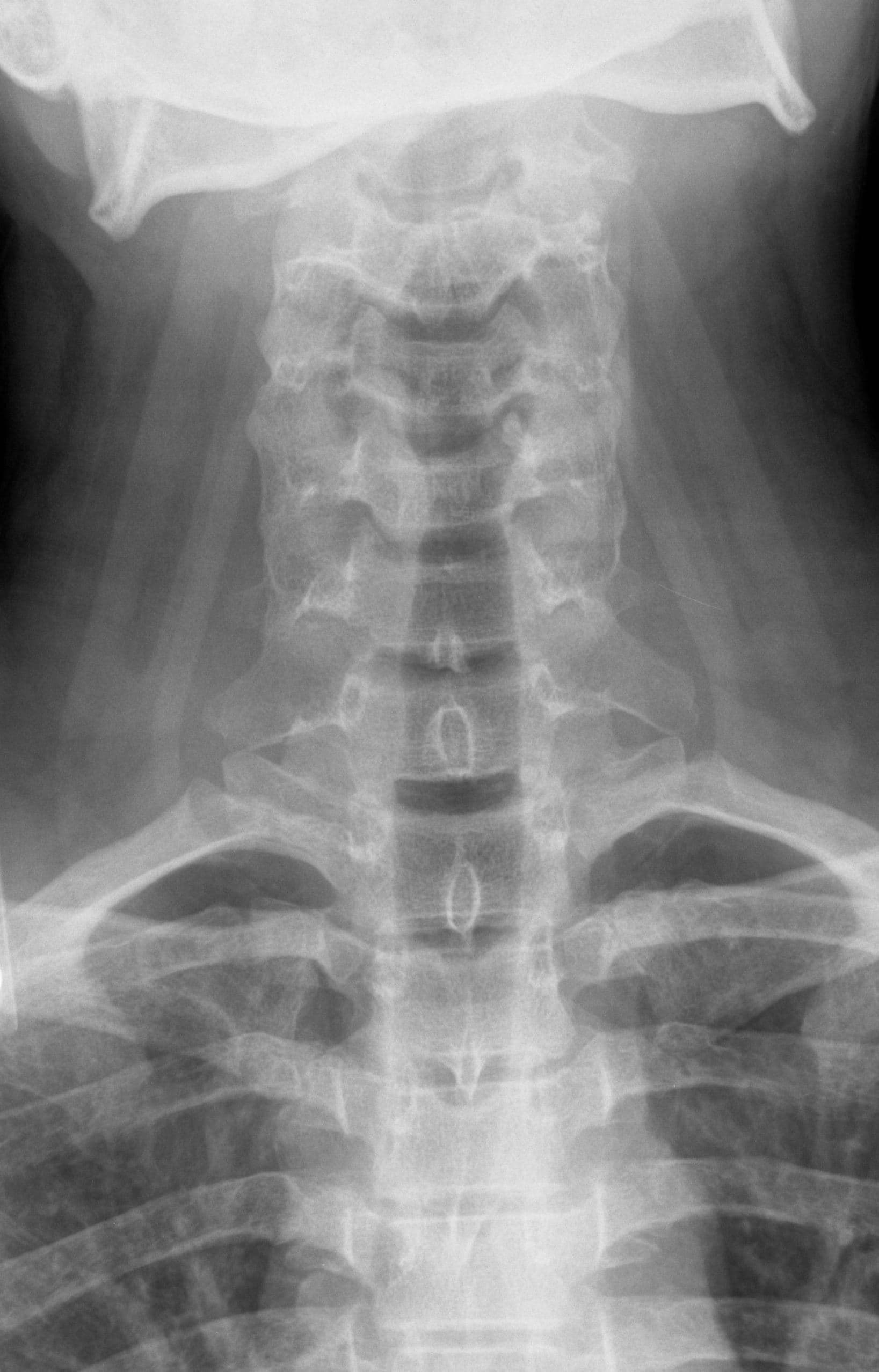 Spine X-ray